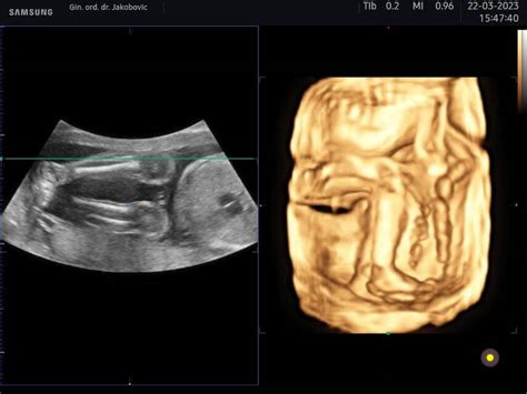 3D/4D ultrazvuk zobrazujúci plod
