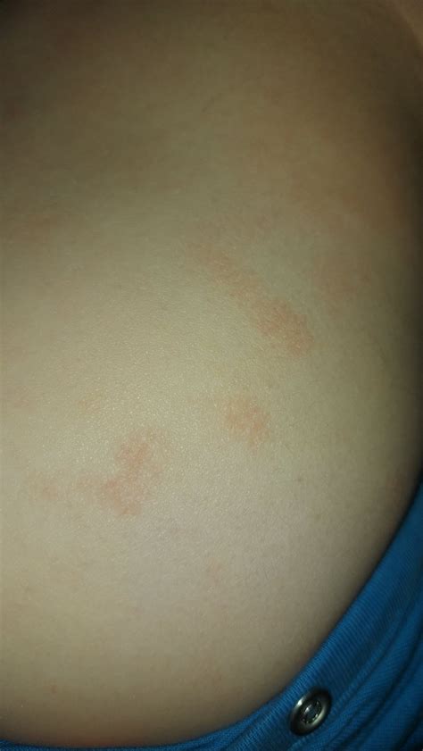 Vyrážky na rebrách u detí: Príčiny, prejavy a liečba