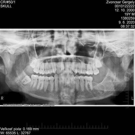 Röntgenová snímka detskej čeľuste ukazujúca vplyv cumlíka