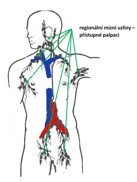 Schéma upchatého mliekovodu v prsníku