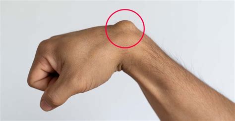 Ilustrácia zábalu na zápästí