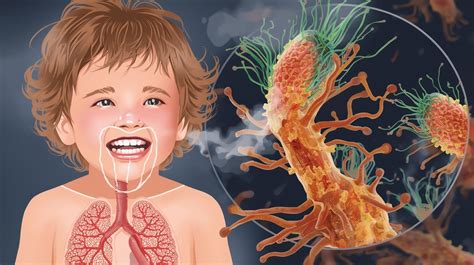 Infografika o liečbe detského kašľa