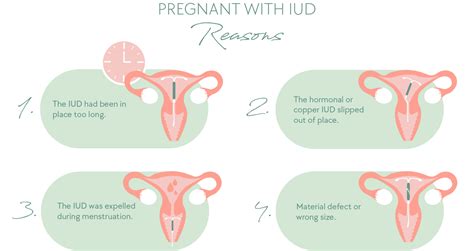 Infografika kontraindikácií pre hormonálne IUD