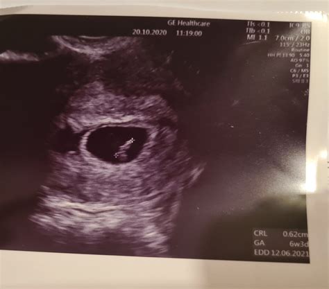 Žĺtkový vak v gestačnom vaku