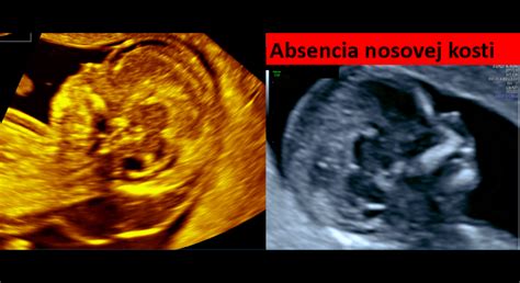 Ultrazvukové zobrazenie plodu v druhom trimestri