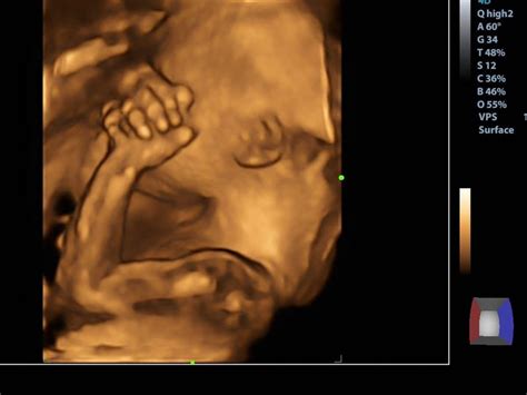 Morfologický ultrazvuk: Kedy sa robí a čo všetko odhalí