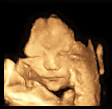 3D ultrazvuk tváre bábätka