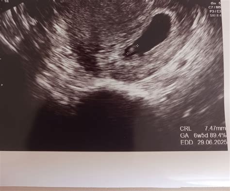 Morfologický ultrazvuk v tehotenstve: Kedy a prečo je dôležitý