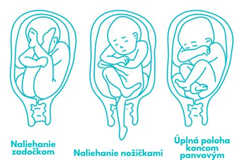 Schematické znázornenie pozdĺžnej polohy hlavičkou nadol (predné a zadné postavenie)