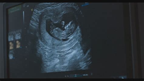 Symbolické znázornenie vajíčkovodu s mimomaternicovým tehotenstvom