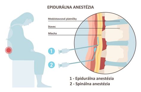 Schéma zavedenia epidurálnej anestézie