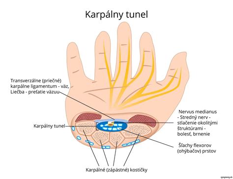 Syndróm karpálneho tunela počas tehotenstva: príznaky a liečba