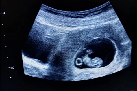 Embryo na ultrazvuku v prvom trimestri