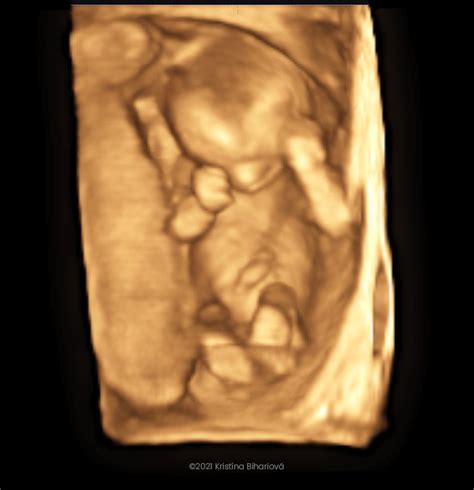 3D ultrazvuk bábätka