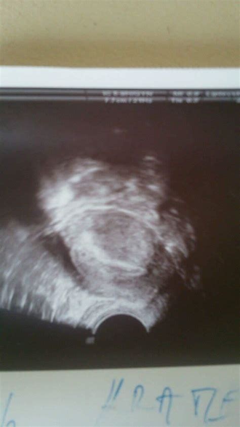 Ultrazvukový snímok znázorňujúci mimomaternicové tehotenstvo.