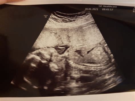 Ultrazvukový snímok bábätka v 21. týždni tehotenstva