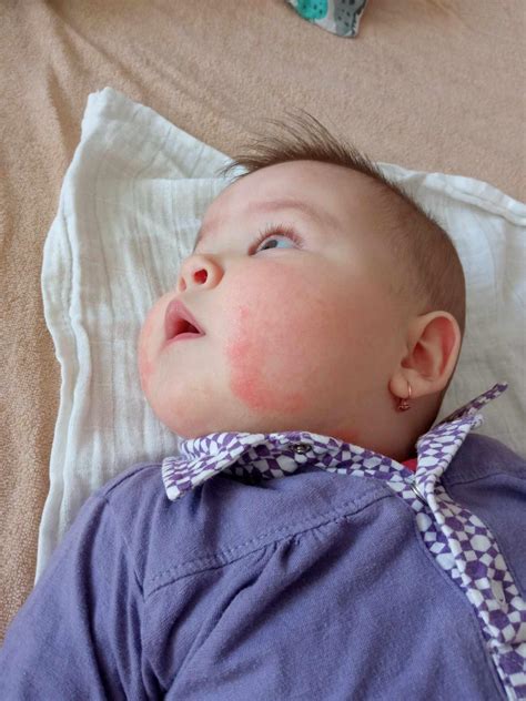 Bocianie znamenie na tvári bábätka