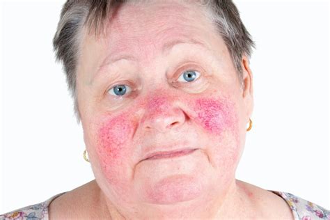 Červené fľaky na tvári po narodení: Príčiny, prejavy a starostlivosť