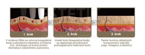 Schéma prieniku HIFU ultrazvuku do vrstiev pokožky