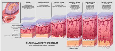 Placenta accreta: rizikový stav vyžadujúci špecializovaný plán pôrodu