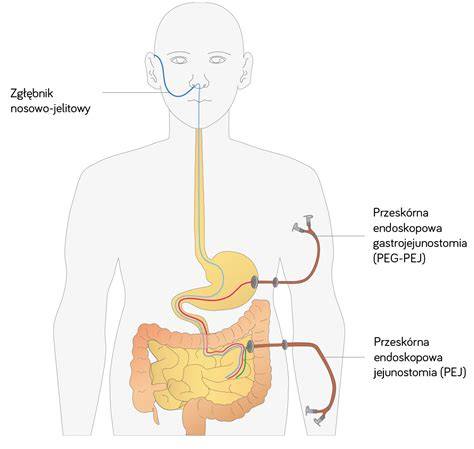Infografika: PEG vs. PEJ vs. výživové sondy - rozdiely a indikácie