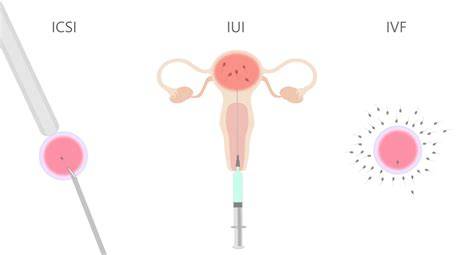Infografika: Schéma procesov asistovanej reprodukcie (IVF, IUI, ICSI) a ich úspešnosti