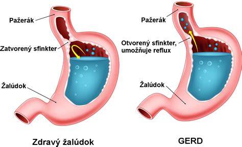 Gastroezofageálny reflux u bábätiek a detí: príznaky, liečba a starostlivosť