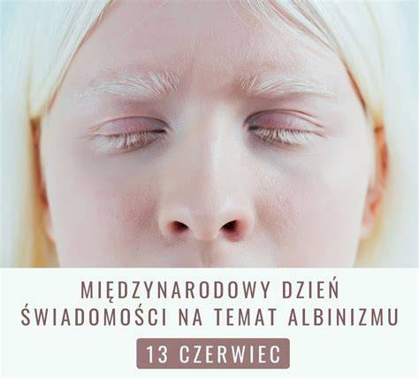 Infografika: Genetické dedičstvo albinizmu a riziko prenesenia na ďalšie generácie