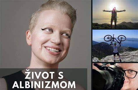 Genetika albinizmu a pravdepodobnosť narodenia dieťaťa s albinizmom