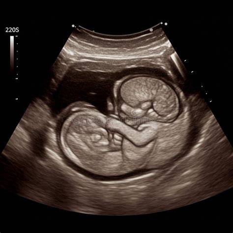 Illustrative ultrasound of 18-week fetus with developing features