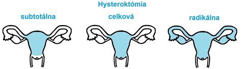 Infografika: Typy placenty accreta a ich invázia do steny maternice