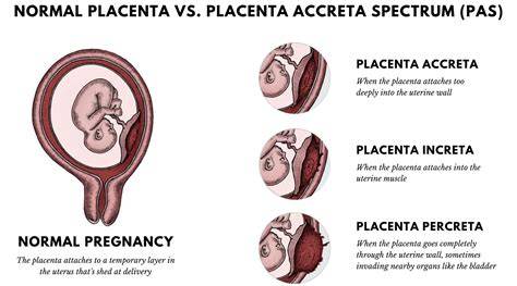 Vizualizácia tretieho pôrodného procesu a jasné znázornenie lokácií placenta