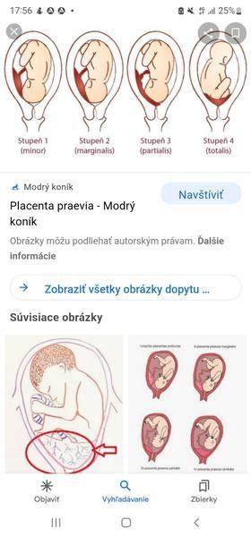 Schéma pripravenosti pôrodných ciest: mäknutie krčka, otvorenie 3-4 cm, tlak dieťaťa do panvy, a finálne 10 cm - vizuálna cesta pôrodu