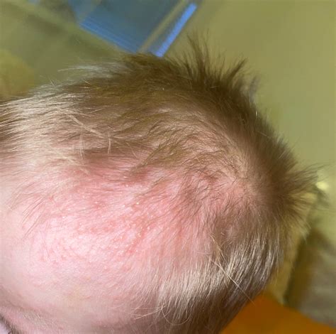 Vyrážky vo vlasoch a za ušami: Príčiny, prevencia a liečba