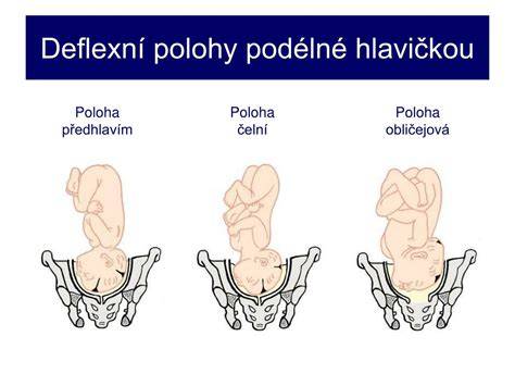 Deflekčné polohy hlavičky plodu počas pôrodu a ich význam pre priebeh prirodeneho pôrodu