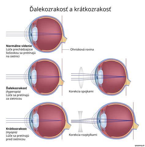 Ilustračný obrázok: mehanizmus progresie krátkozrakosti a ochranné opatrenia