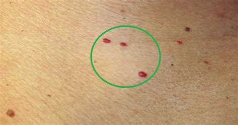 Diéta a červené bodky na tele: príčiny, starostlivosť a prevencia