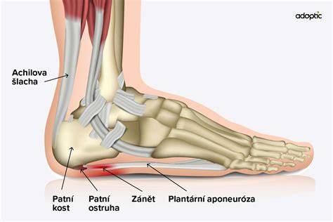 Schéma anatomie Achillovej šľachy a zóny stuhnutia
