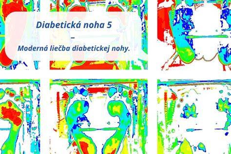 Mapa rizík diabetickej nohy a priečne fragmenty liečby
