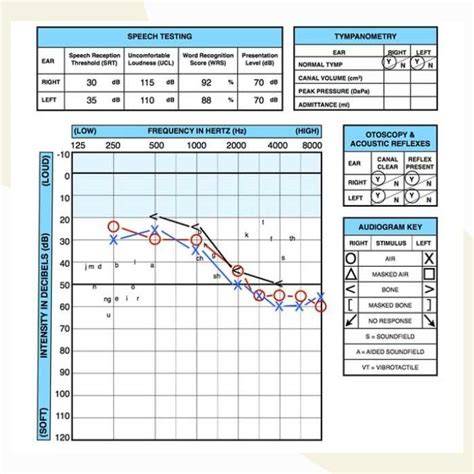 Obrázok: Audiogram a interpretácia výsledkov