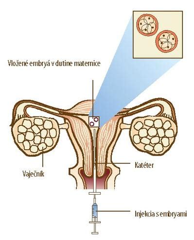 Embryotransfer do maternice
