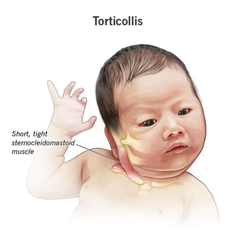 detský torticollis