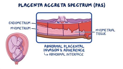 Ilustrácia: Placenta accreta - komplikácia počas tehotenstva