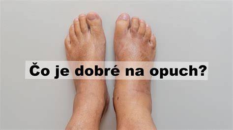 Infografika: Ako prebieha opuch nôh a čo ho spôsobuje