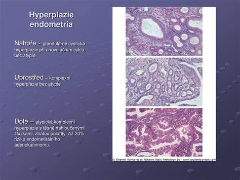 Schéma typov hyperplázie endometria (typ bez atypie vs. atypická/EIN)