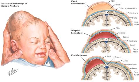 Infografika: Kefalhematóm vs. Caput succedaneum - rozdiely a priebeh