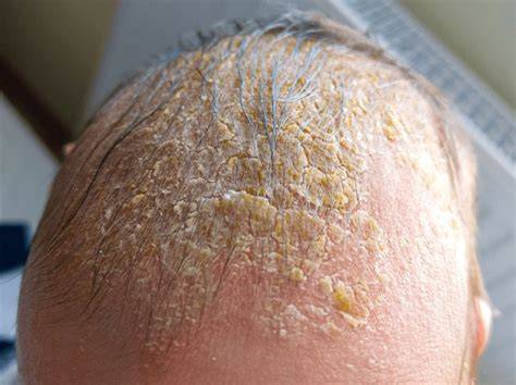 Šupinky na hlave u novorodenca: príčiny, priebeh a liečba mliečnej chrasty (crusta lactea) a seboreickej dermatitídy