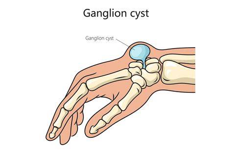 Infografika: Ganglion cysts in the wrist - pôvod, lokalizácia, liečba a riziká