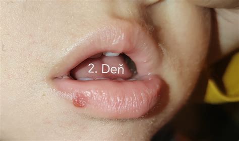 Herpes u ročného dieťaťa: príznaky a liečba