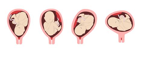Schéma zobrazujúca rôzne polohy plodu v maternici